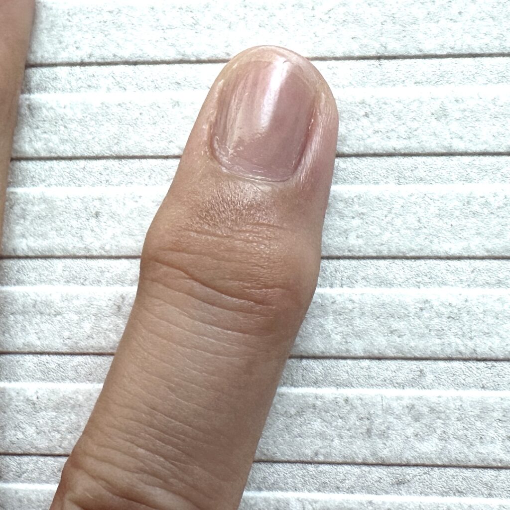 ヘバーデン結節の指